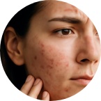 Problematická pokožka a akné | Superpotraviny-Naturalis.cz Problematická pokožka a akné | Superpotraviny-Naturalis.cz